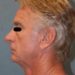 Facelift Before & After Patient #6506
