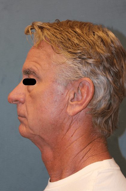 Facelift Before & After Patient #6506