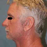 Facelift Before & After Patient #6506