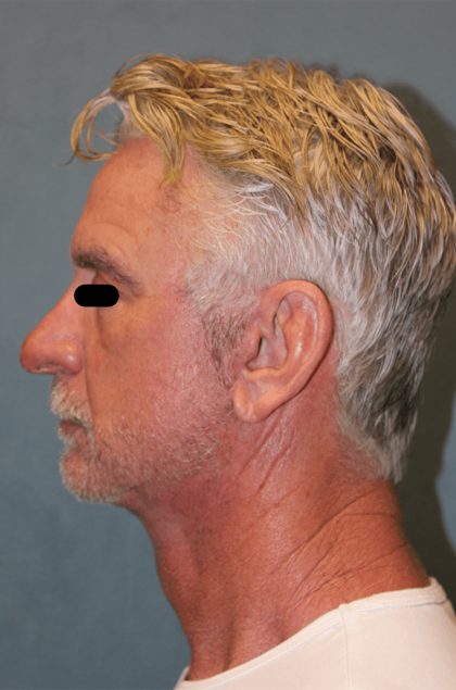 Facelift Before & After Patient #6506