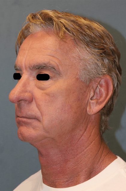 Facelift Before & After Patient #6506