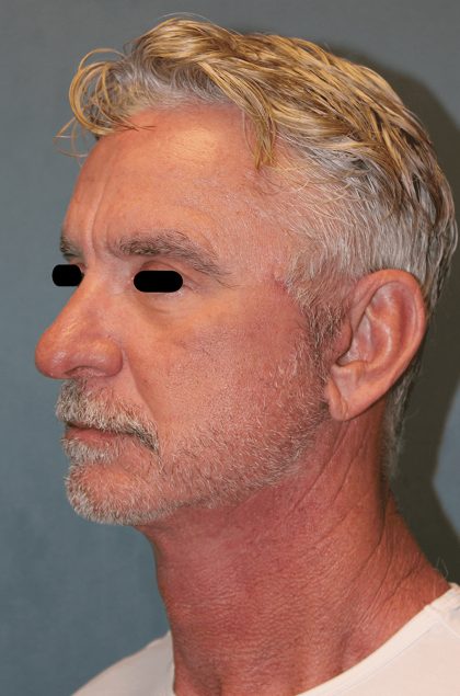Facelift Before & After Patient #6506