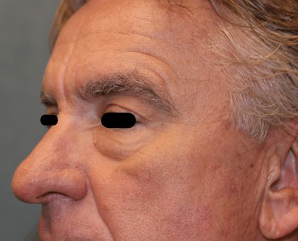 Facelift Before & After Patient #6506