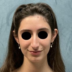 Rhinoplasty Before & After Patient #6539