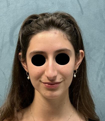 Rhinoplasty Before & After Patient #6539