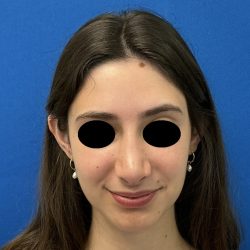 Rhinoplasty Before & After Patient #6539