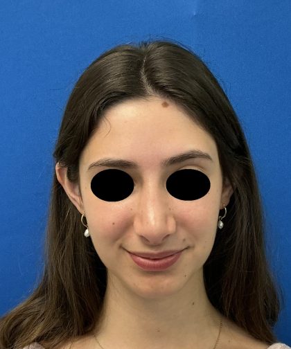 Rhinoplasty Before & After Patient #6539